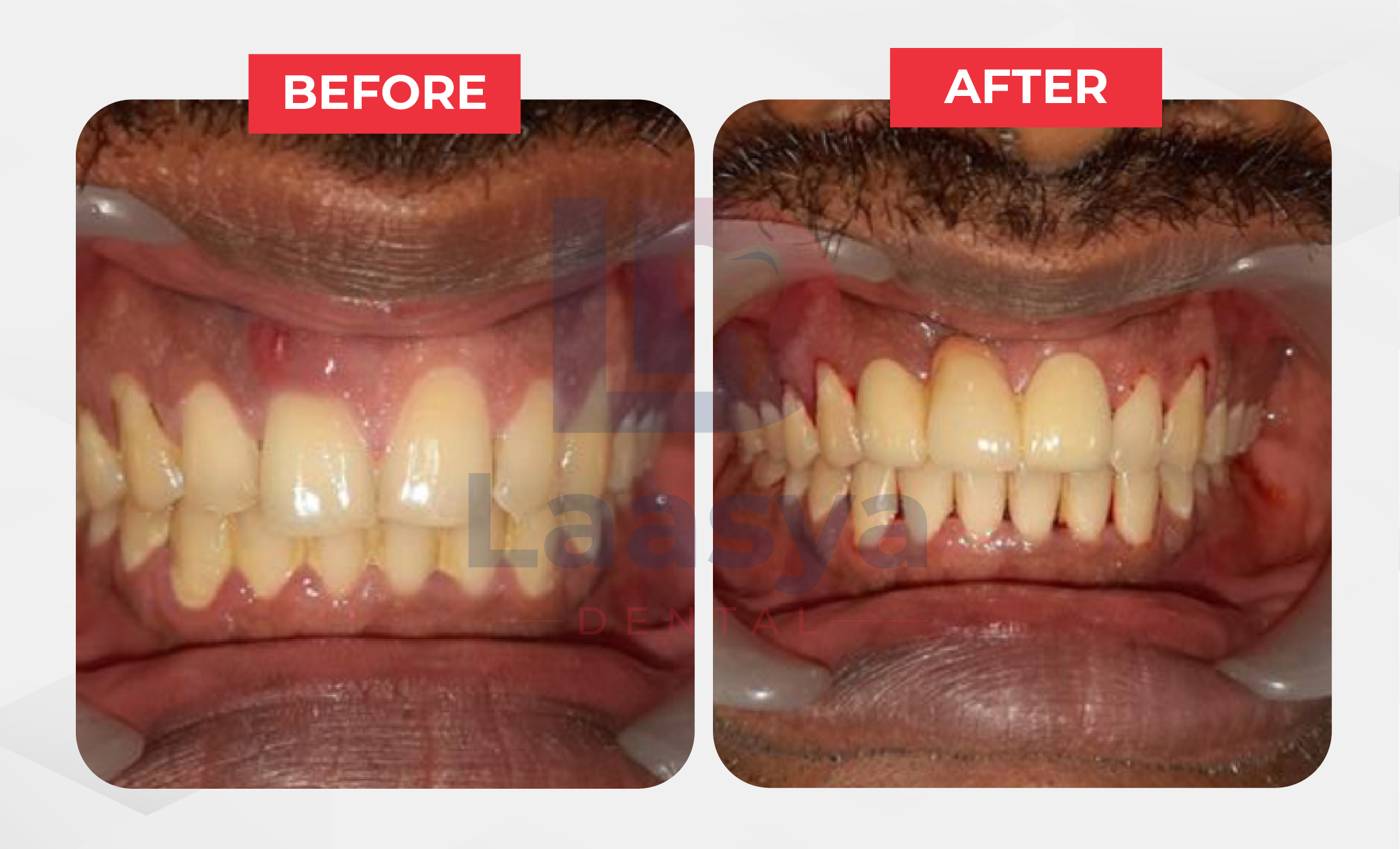 Before and after crowded teeth smile correction at Laasya Dental in Visakhapatnam