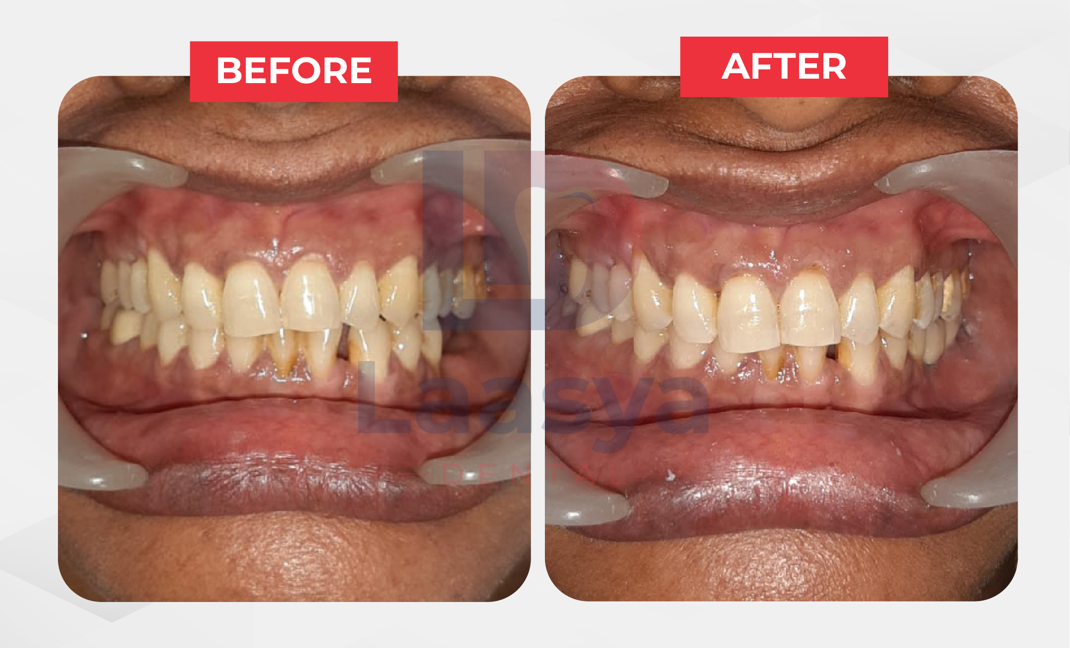 Before and after cosmetic restoration of the front teeth at Laasya Dental in Visakhapatnam