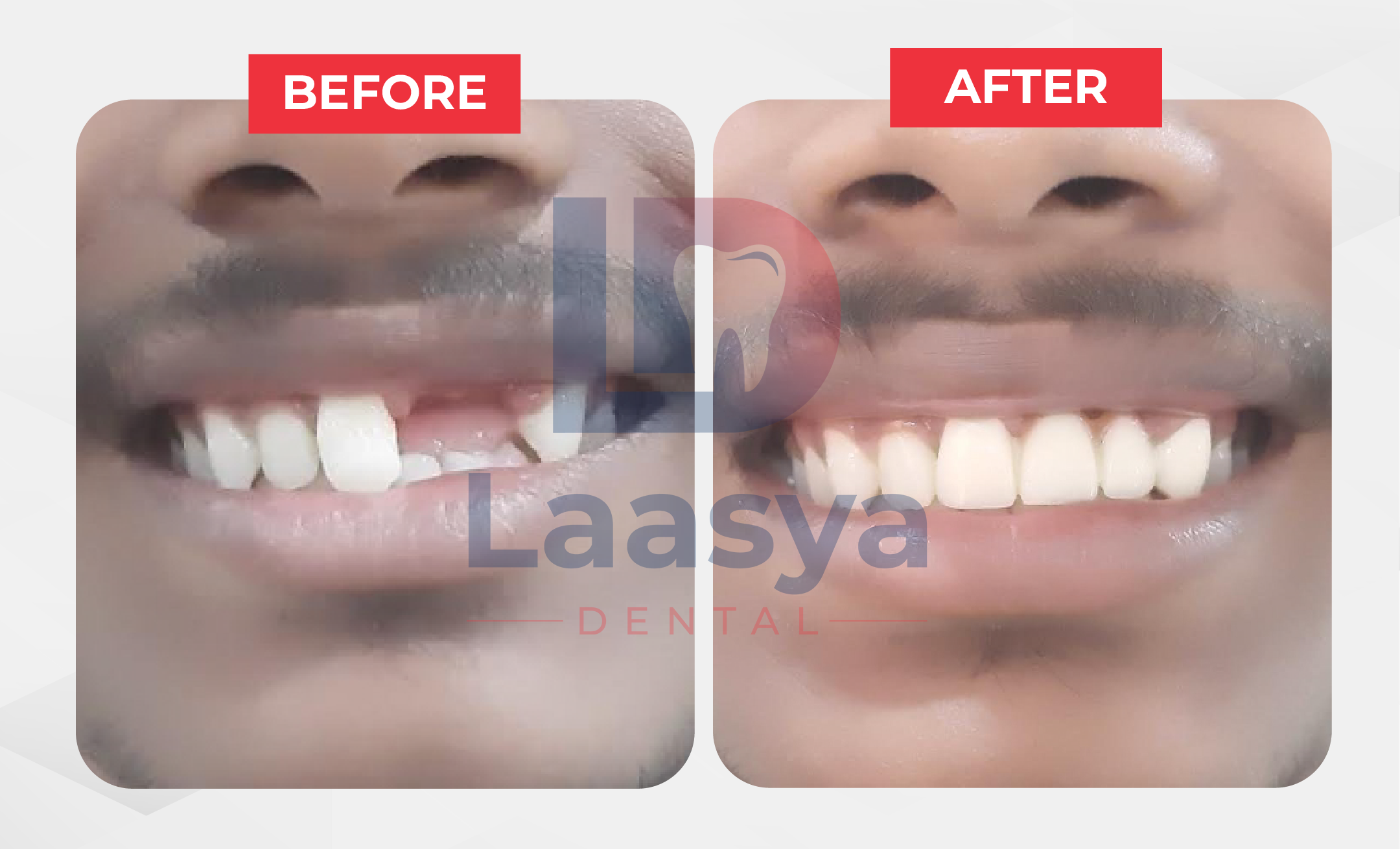 Before and after restoration of a front teeth gap at Laasya Dental in Visakhapatnam