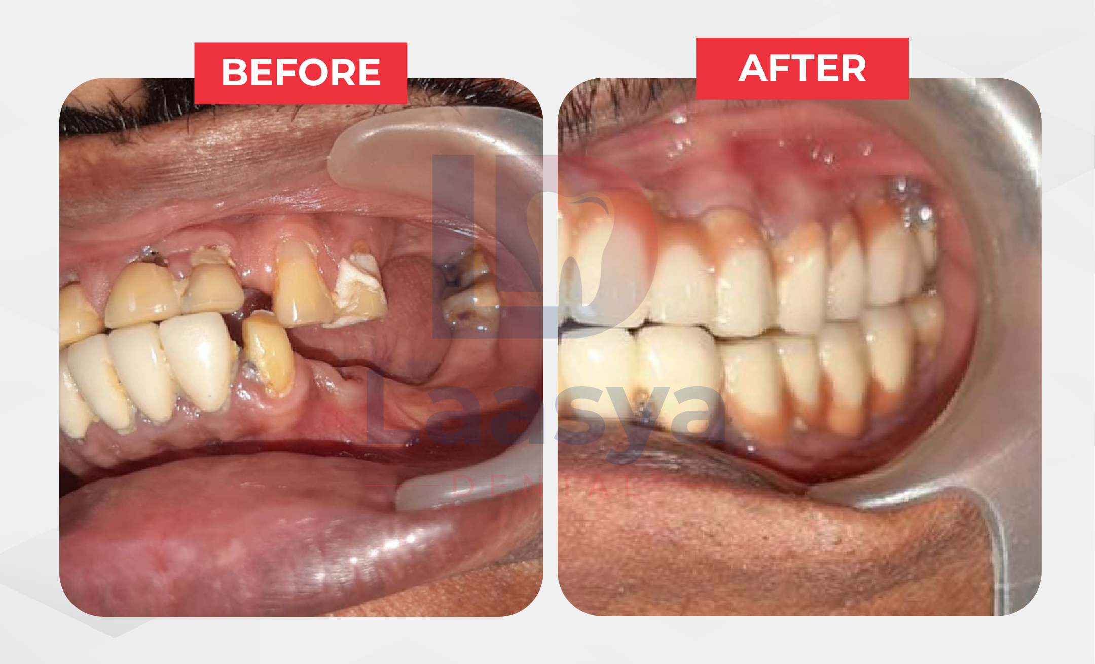 Before and after full-mouth dental restoration at Laasya Dental in Visakhapatnam