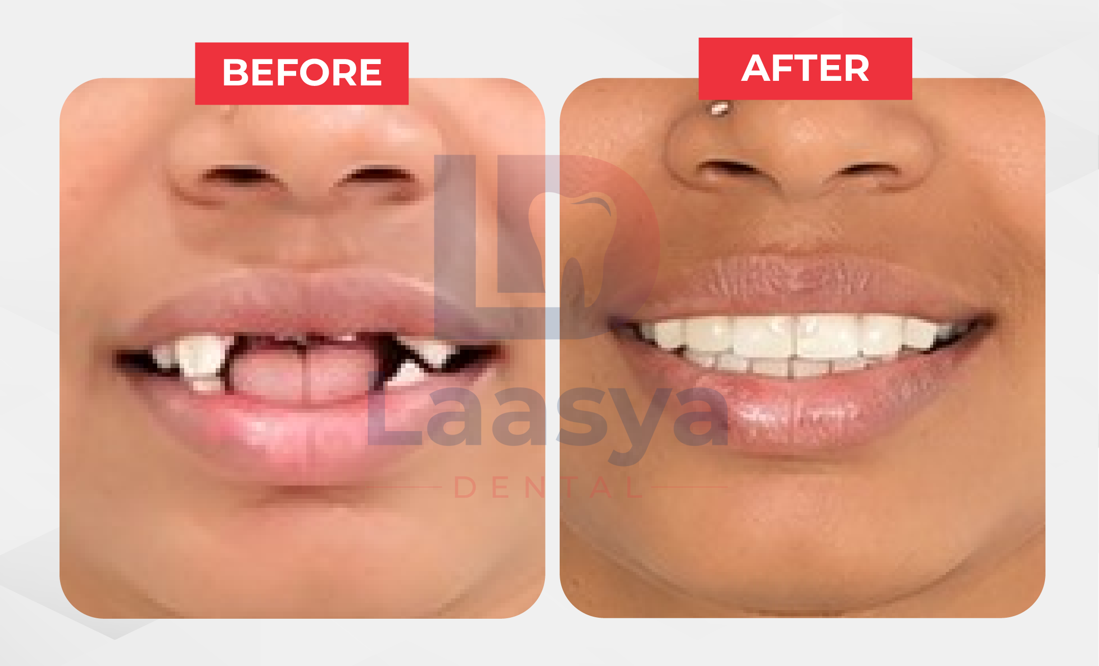 Before and after missing front teeth smile restoration at Laasya Dental in Visakhapatnam