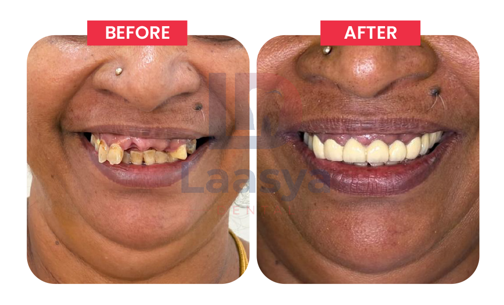 Before and after missing front teeth smile restoration at Laasya Dental in Visakhapatnam