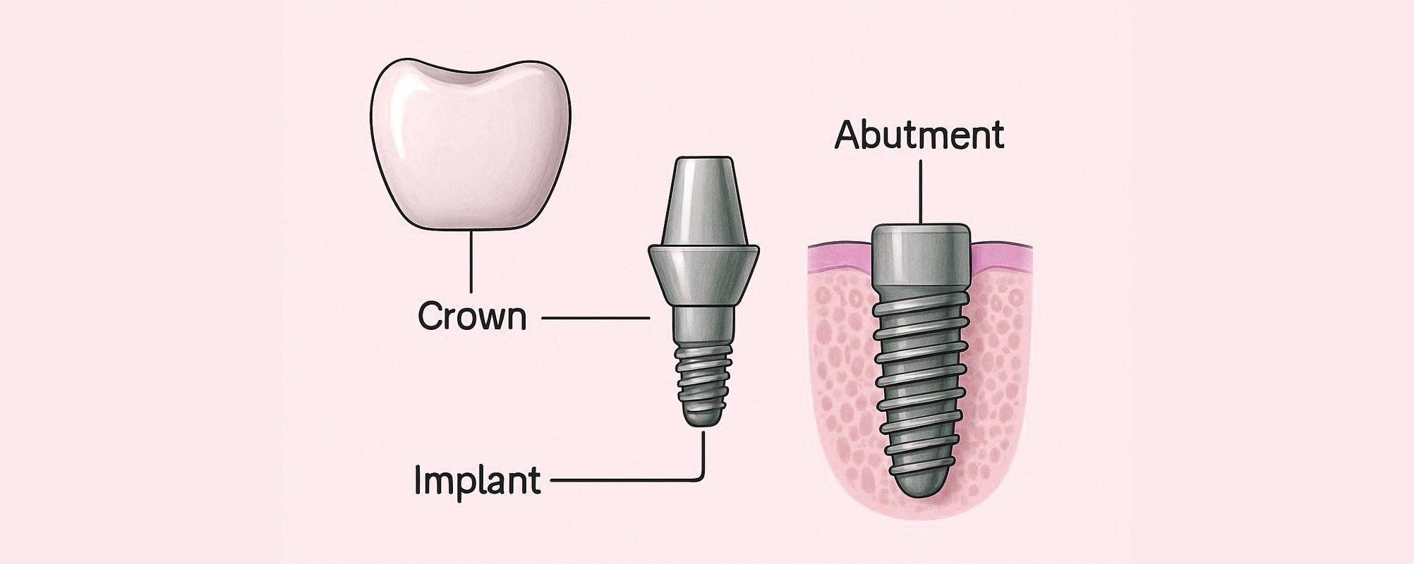 Diagram showing dental implant components