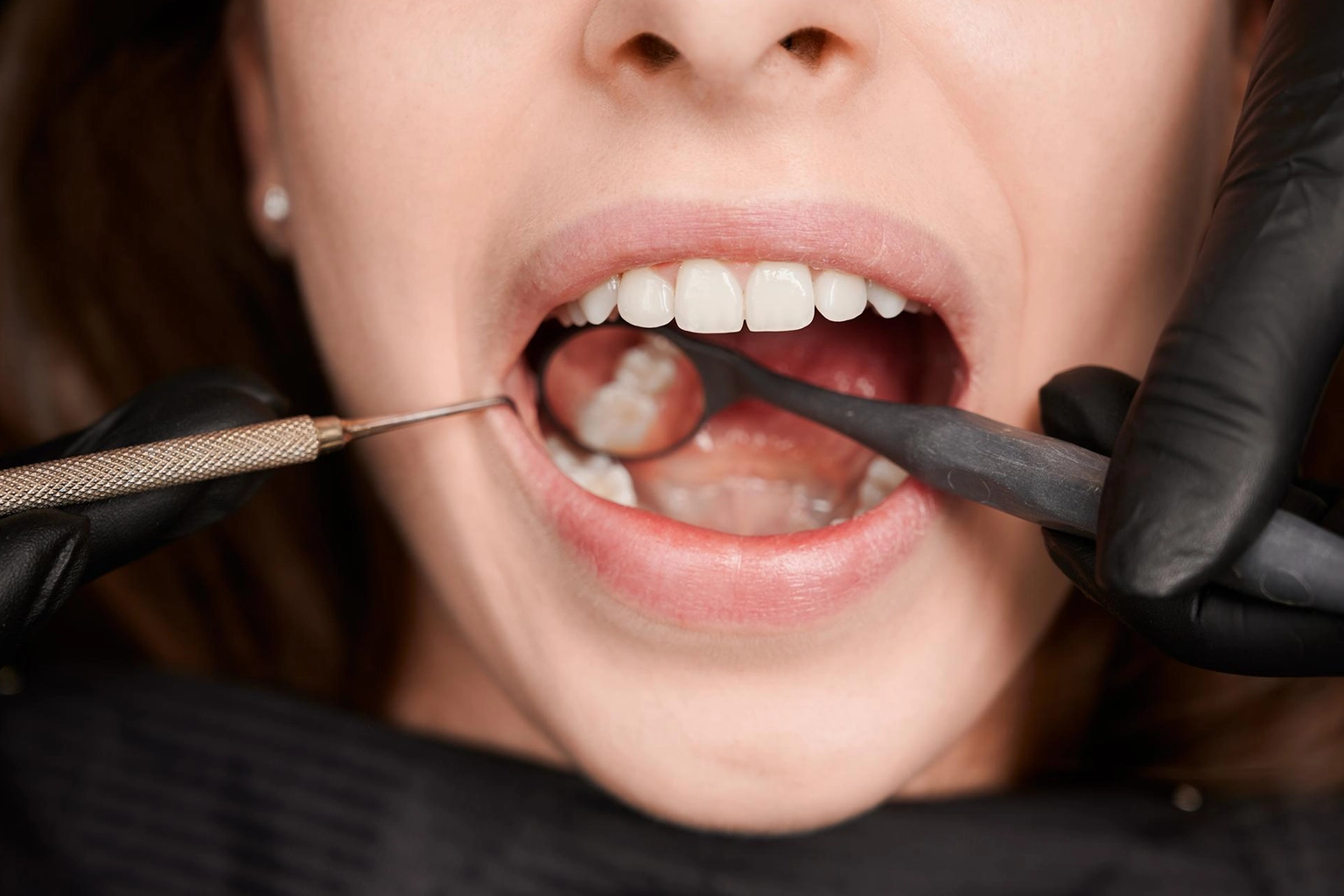 wisdom tooth